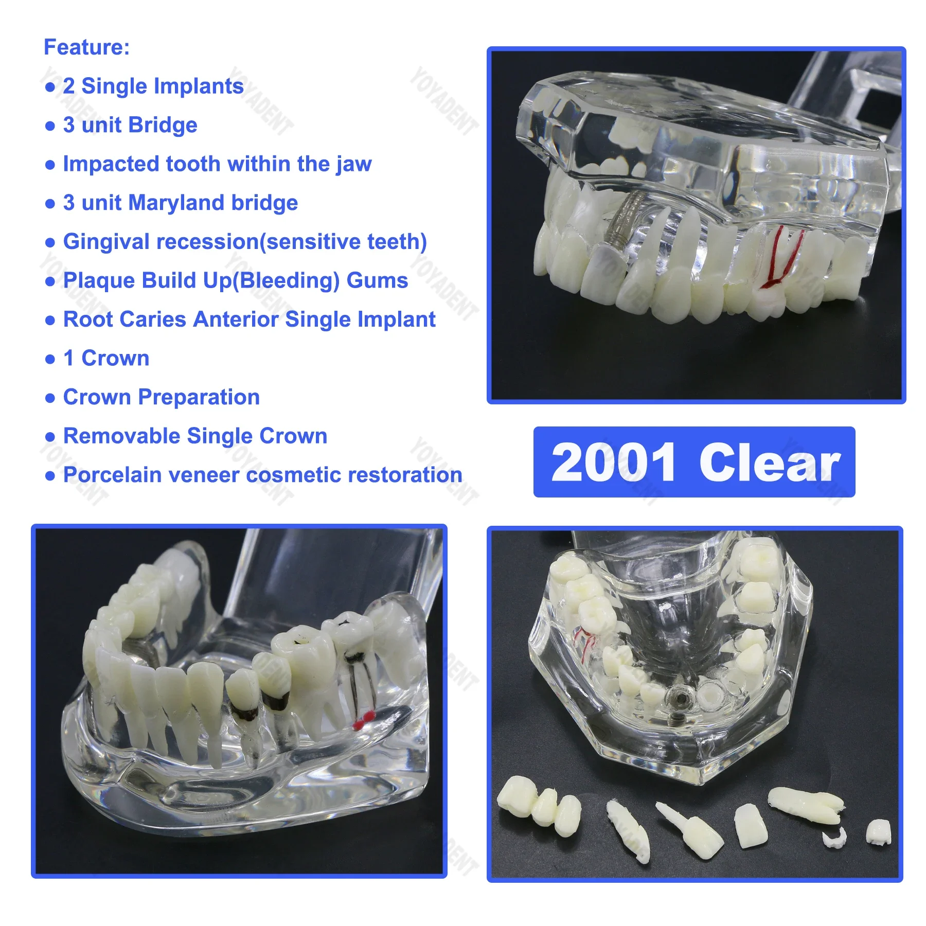 Dental Teeth Repair Model Disease Teeth Model for Dentist Student Practice Training Studying Oral Medical Dentistry Tools