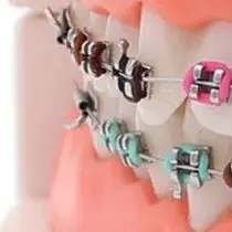 

Dental Orthodontic Treatment Model with Ortho Metal Bracket Arch Wire Buccal Tube Ligature Ties