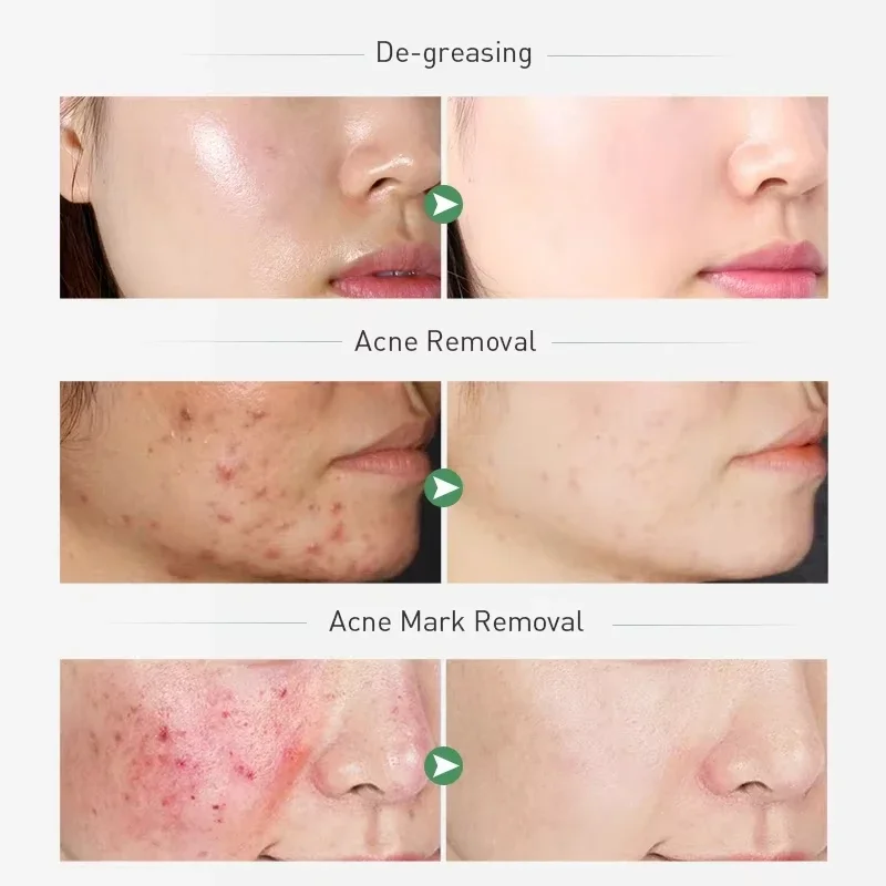 مجموعة العناية بالبشرة من LAIKOU للعناية بالبشرة - طقم مكون من 5 قطع للتحكم في زيت شجرة الشاي مع منظف للوجه ومرطب وكريمة ومصل وحبر للزيت