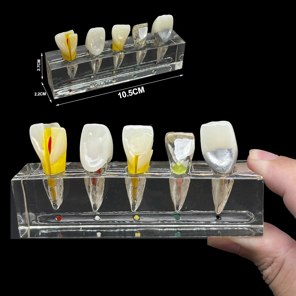 Dentist Models Endodontic Pathological Anterior Front Labial Teaching  Orthodontic Model Dentistry Products Accessories