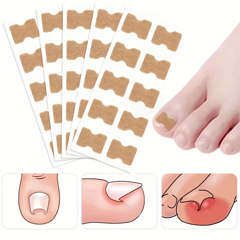 첫 번째 무접착제 패치, 손톱 손발톱 유물, 특수 교정, 점차적인 교정