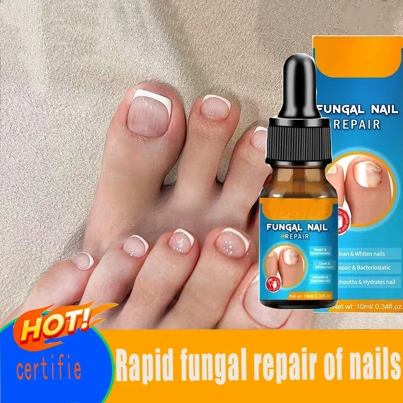 

Anti Infection Paronychia Onychomycosis Nail Fungus Treatment Serum Toe Fungal Repair Products Hand Foot Care Removal Gel