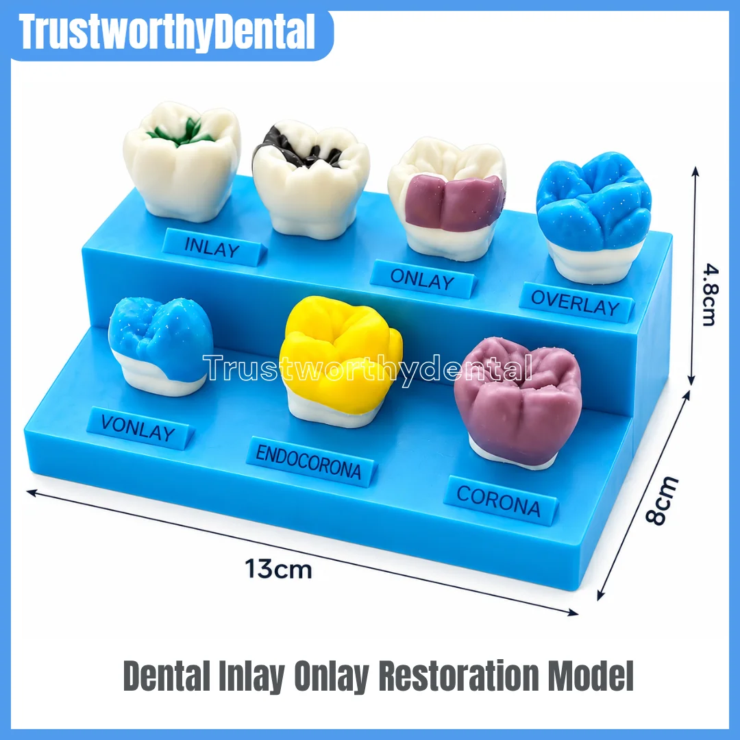 Dental Teaching Tooth Model Removable Inlay Crown Display Model High Onlay Restoration Demo Teeth Model Patient Communication