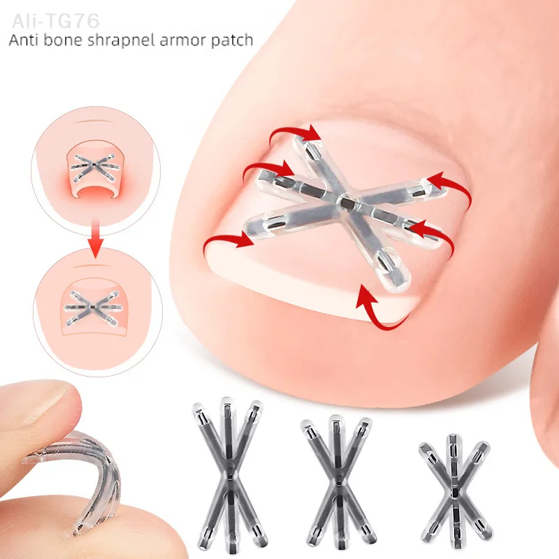 مجموعة أدوات تصحيح أظافر القدم الغارزة مكونة من قطعتين مع أدوات باديكير لاصقة مرنة لاستقامة وعلاج أظافر القدم