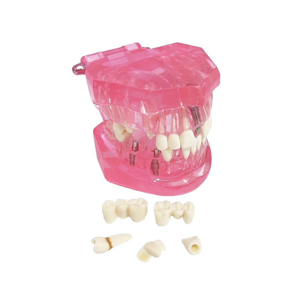 Dental Model Teeth Implant Restoration Bridge Teaching Study Medical Science Disease Analysis Model Dentist Dentistry Materials