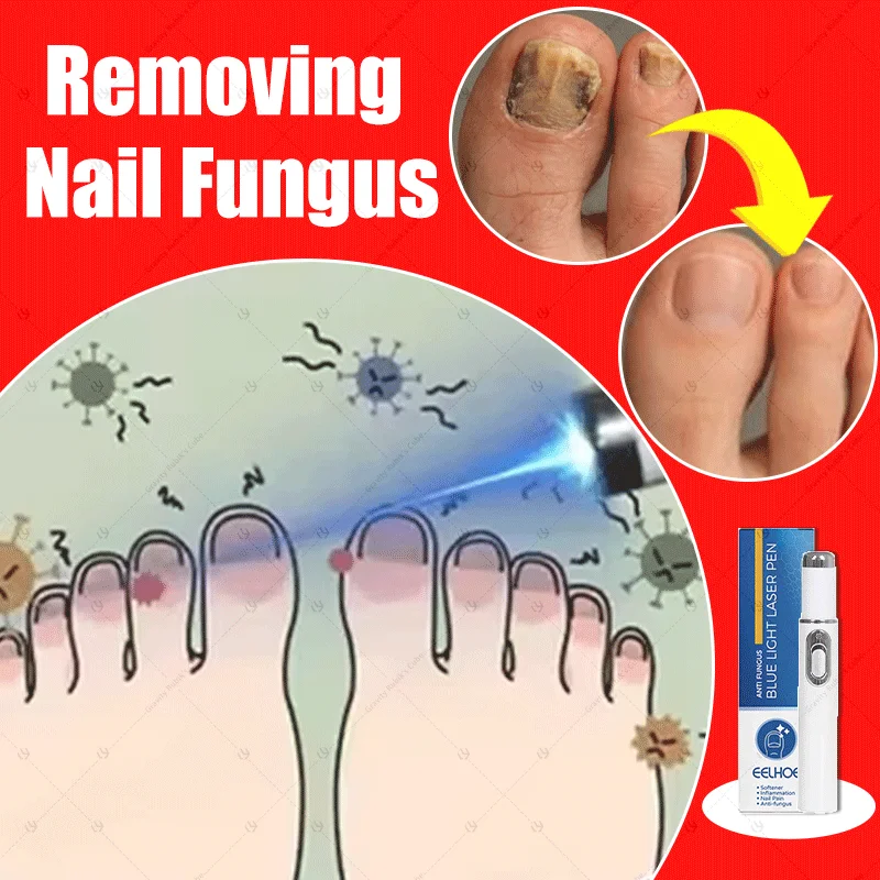 

Laser pen for nail care