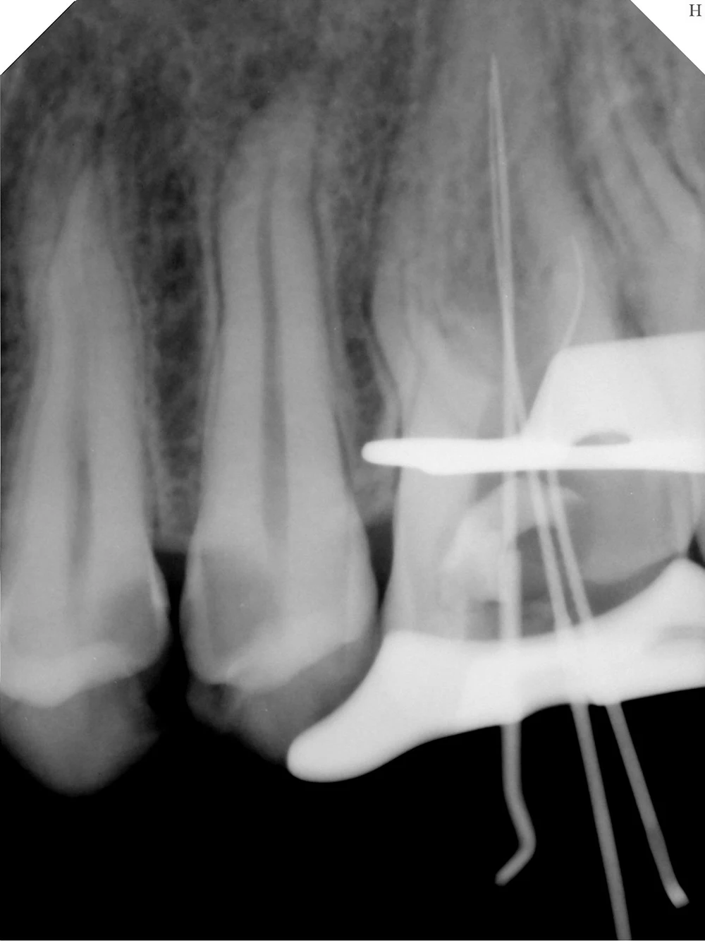 Dental RVG Tooth X-ray Sensor Digital Image System HDR 500A 600A