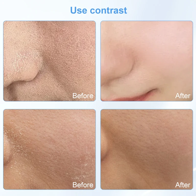 Machine portative de microdermabrasion de diamant exfolie les points noirs vergetures d'acné 9 accessoires pour le traitement du visage et du corps