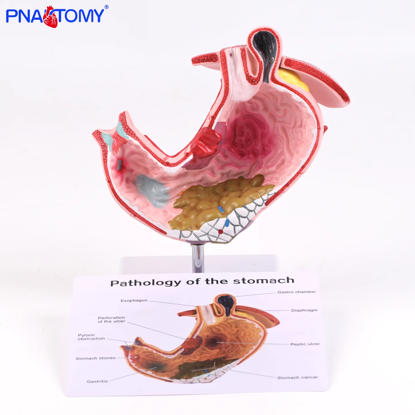 Pathological Human Stomach Model for Teaching Disease Anatomy Internal Organ Model for Medical Education Digestive Anatomical