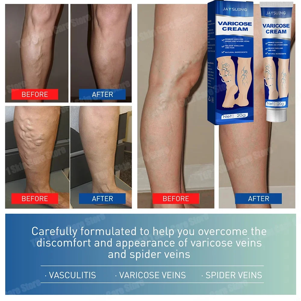 Safe and effective varicose vein ointment effectively alleviates vasculitis, lower limb varicose vein excision cream