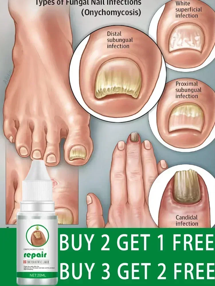 Fungus Manicure Treatment Foot Serum Foot Whitening Toenail Fungus Removal Gel Anti-Infectious Paronychia Onychomycosis