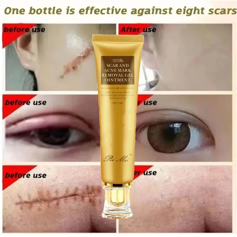 Fast Scar Removal Cream Treatment Stretch Marks Burn Surgical Scars Acne Spot Repair Whiten Moisturizing Skin Care Beauty Health