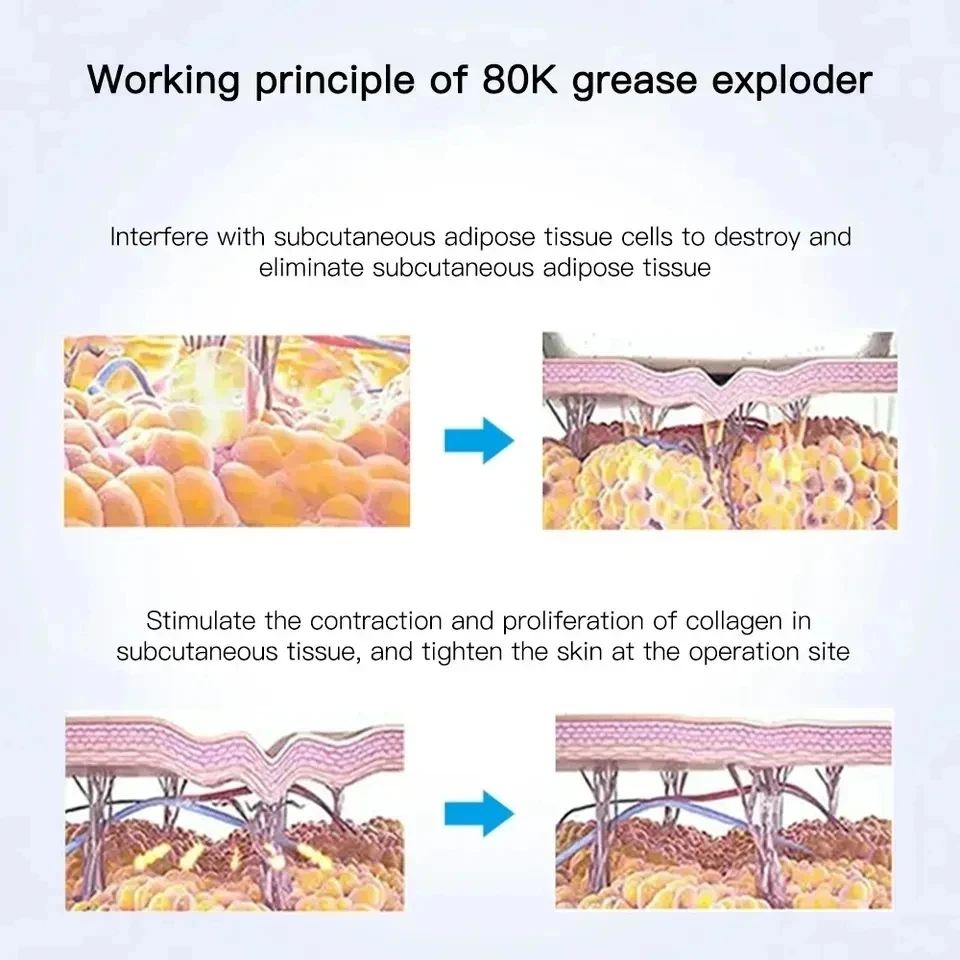 آلة التجويف لحرق الدهون ، 6 في 1 ، 80K ، فقدان الوزن ، تنحيف الجسم ، شعبية