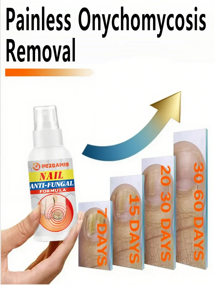 Spray antimicótico para uñas: limpia las uñas dañadas y descoloridas, fácil de usar.