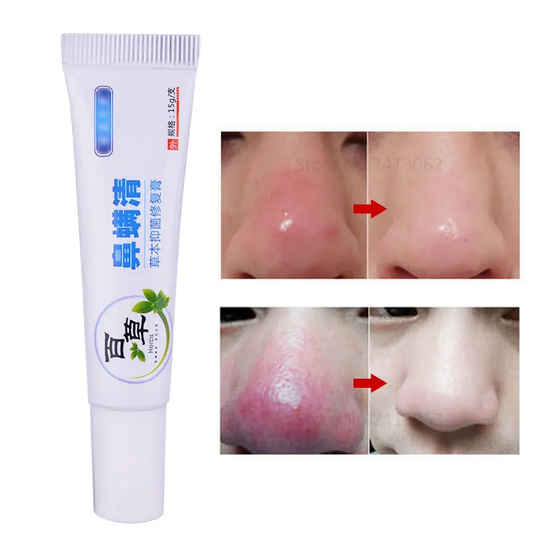 

Herbal Anti Nose Mites Remove Acne Rosacea Cream Red Nose Blackhead Remover Acne Treatment Shrink Pores Face Bleaching Ointment