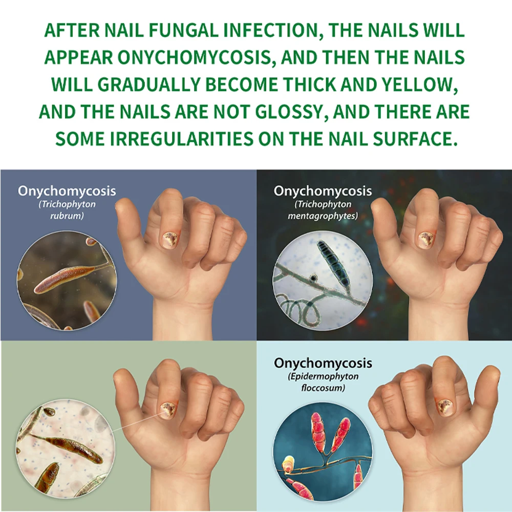 Fungal Nail Treatment Device Repair Fast Nails Fungus Onychomycosis Repair Toenail Fingernail Removes Nail Fungus Foot Care