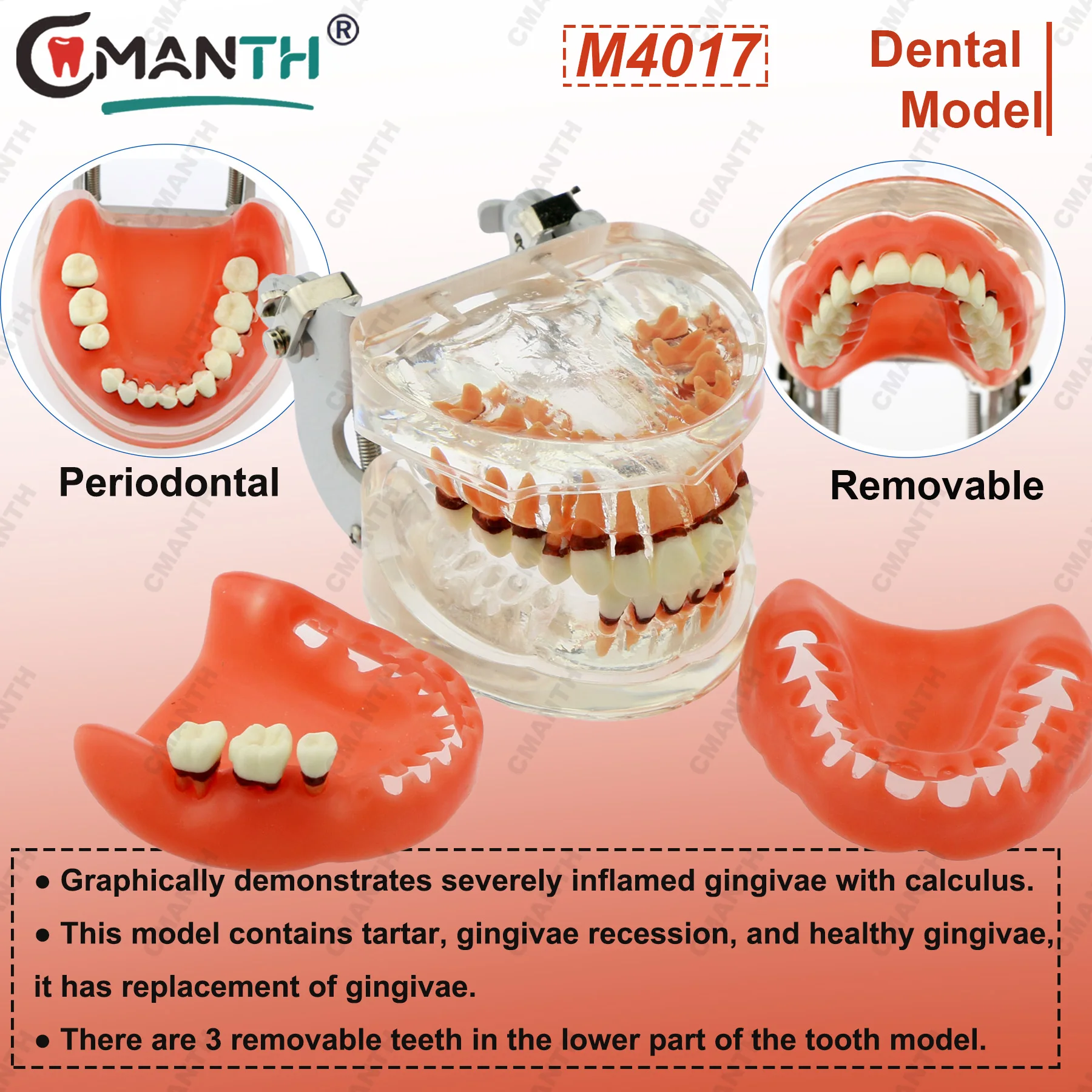 Dental Model Resins Periodontal Disease Pathological Teaching Model For Dentist Dental Students Studying Education Display M4017
