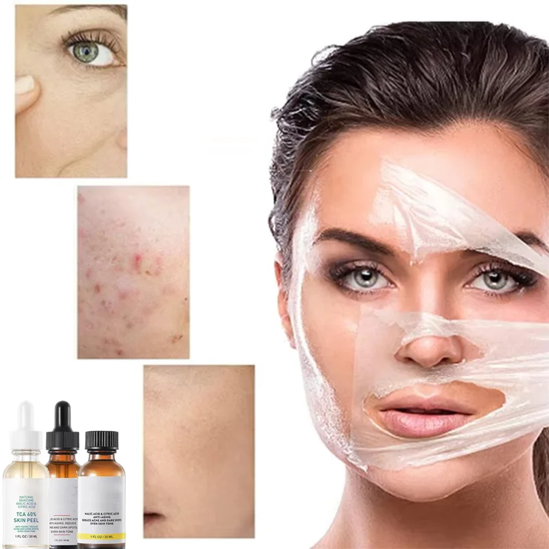 

30ml 40% 45% 50% Peel Acid Skin Peel Peeling Aid Serum Skin Skin Peel 20% Trichloroaectic Serum Wrinkles