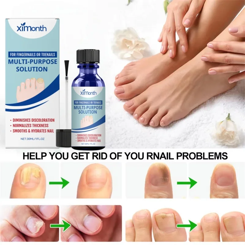 7days Nagel Pilz Behandlung Serum Ingwer Anti-infektiöse Paronychie Onychomykose Kappe Fuß Nagel Pilz Reparatur Gel Hand Fuß pflege