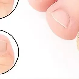 10 個足の爪真菌パッチ爪修理パッチ爪陥入矯正ステッカー変色または損傷した爪ケア