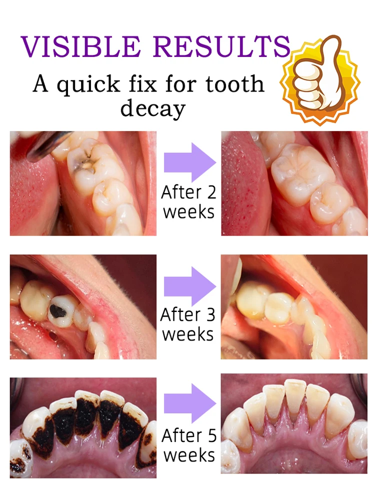 Almost All kind of cavities can be repair by this product