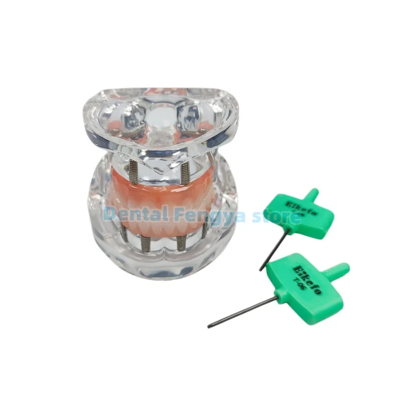 Dental Transparent Implant Teeth Model Upper Jaw All on 4 Overdenture Model With 4 Removable Screws Restoration Model