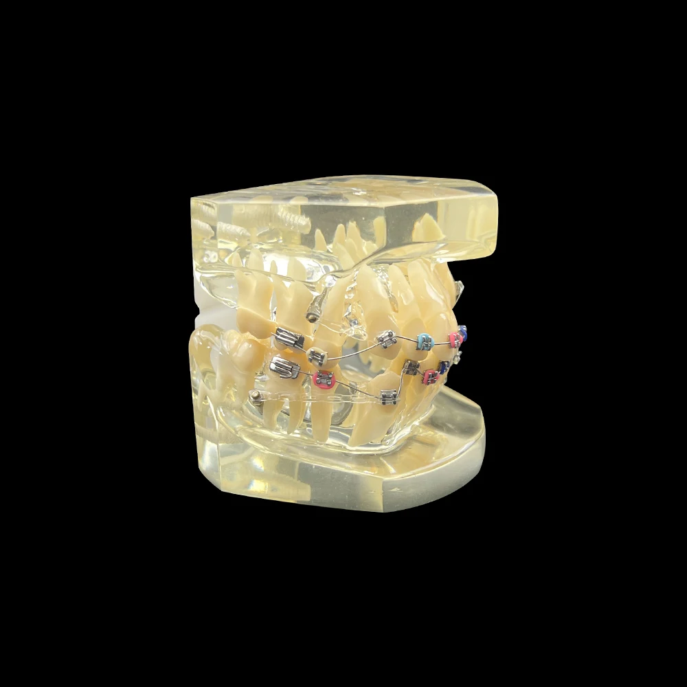 1Pc Tooth Model with Metal Bracket Colored Ligature Anchor Pin Orthodontic Treatment of Malocclusion Study Typodonts Tooth Model