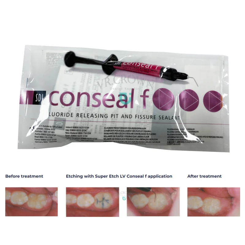 

Dental Sealant for Preventing Cavities SDI CONSEAL F Resin-Based Fluoride Sealant Light Cured Conseal F Pit & Fissure Sealant