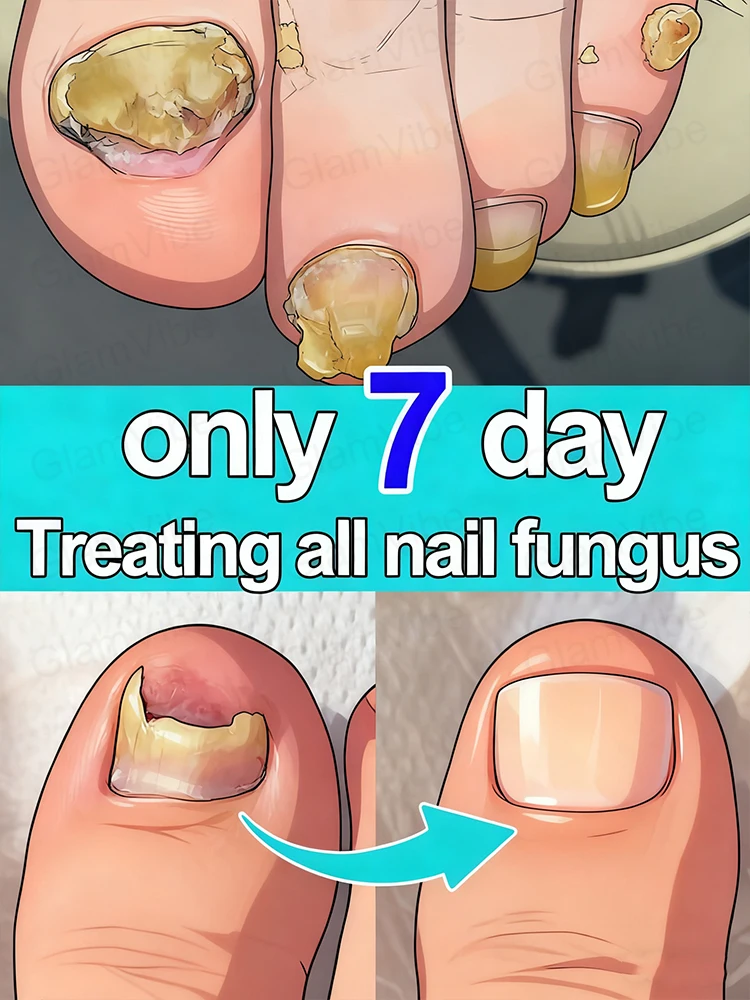 

Tʀᴇᴀᴛᴍᴇɴᴛ ᴏғ ᴏɴʏᴄʜᴏᴍʏᴄᴏsɪs (ғᴜɴɢᴀʟ ɪɴғᴇᴄᴛɪᴏɴ ᴏғ ᴛʜᴇ ɴᴀɪʟs).