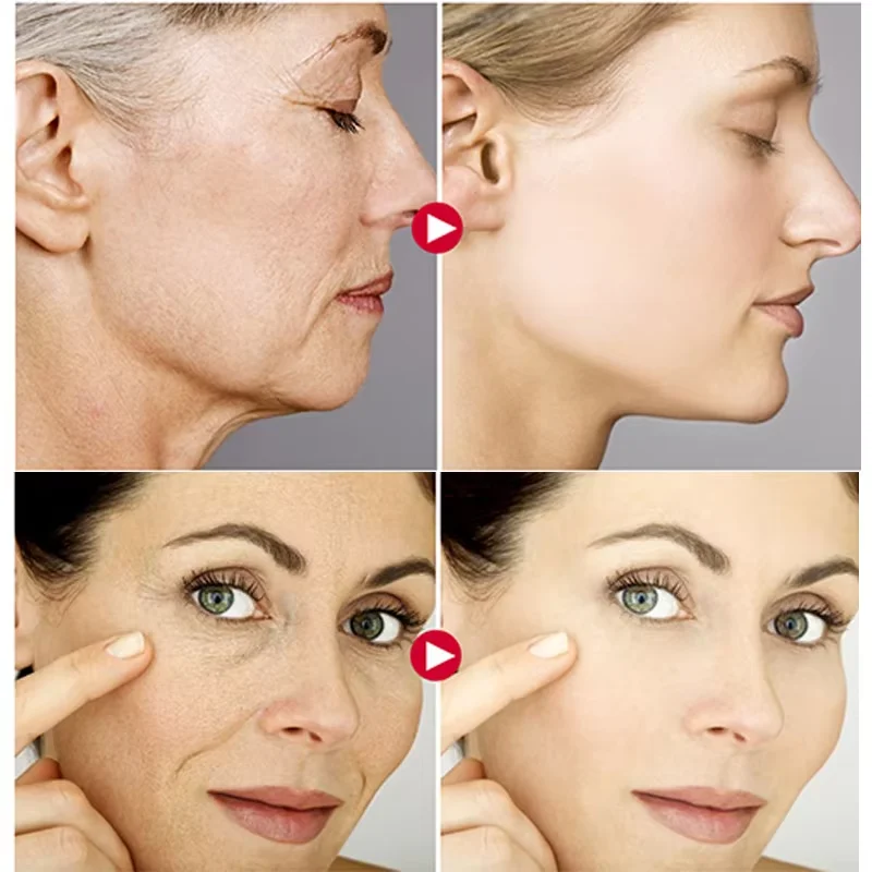 Collageen Eiwit Patche Instant Rimpel Remover Serum Set Lifting Verstevigende Oplosbare Absorbeerbare Gezicht Filler Anti-aging Huidverzorging