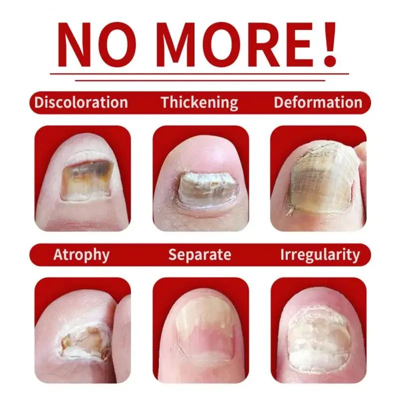 7 일 손톱 곰팡이 트리트먼트 세럼, 발 케어 에센스, 조갑진균증 감염 방지, 발가락 손톱 곰팡이 제거 젤