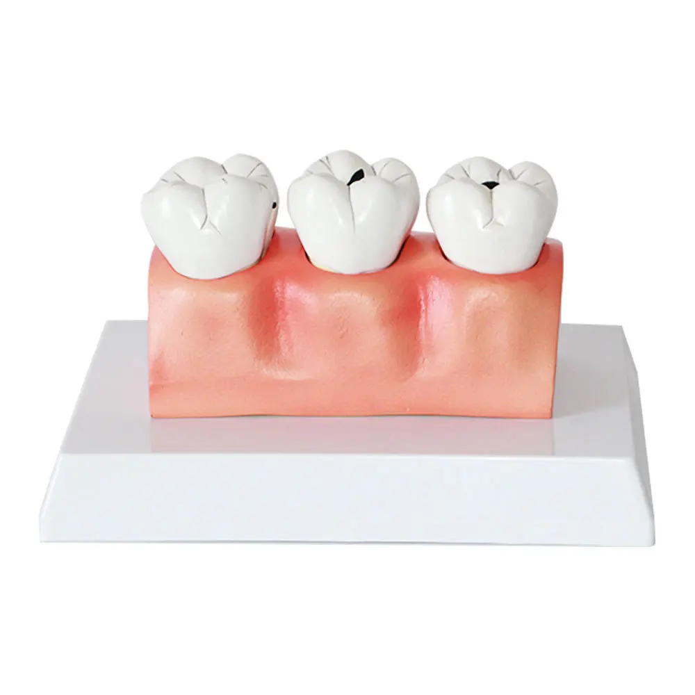 

Dental Department: Pediatric Insect Tooth Decay Model, Pathological Caries Anatomy Model