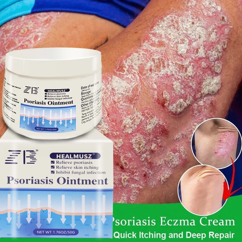 

50g Psoriasis Cream Dermatitis Eczema Skin Care Rash Urticaria Desquamation Treatment Antibacterial Relief Itch Ointment