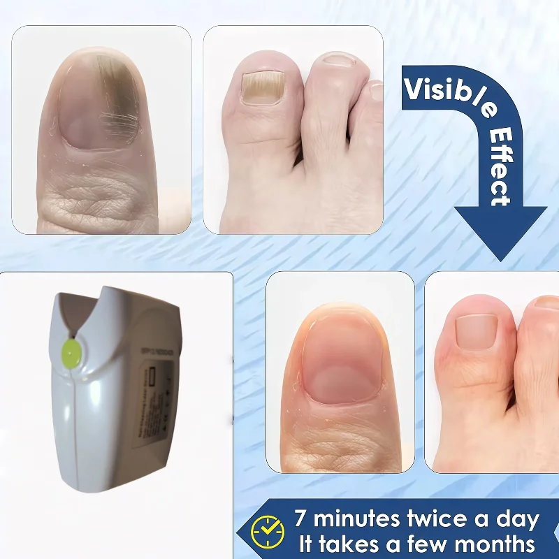

White Fungal Nail Laser Device Repair Nails Fungus Onychomycosis Nail Fungus Cleaning Laser Device Foot Nail Care Tools
