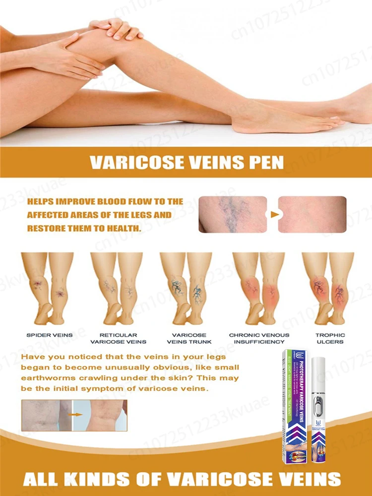 La génération-2 laser dit au revoir aux varices des jambes d'araignée en 7 jours