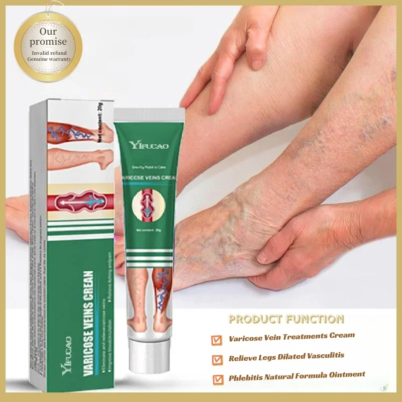 Varicose Vein Treatments Cream Effective Relieve Legs Dilated Vasculitis Phlebitis Natural Formula Ointment For Varicose Veins