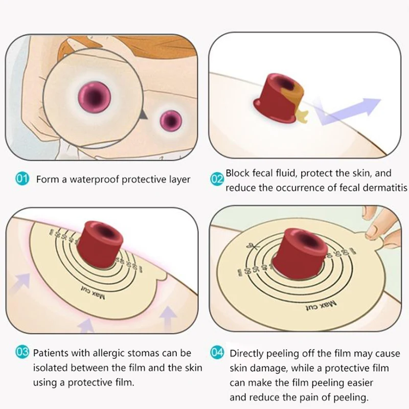 Newest Ostomy Skin Membrane Anti-Injury Wound Exudate Causing Damages Recovery Skins Protective Film Nursing Tools Supply