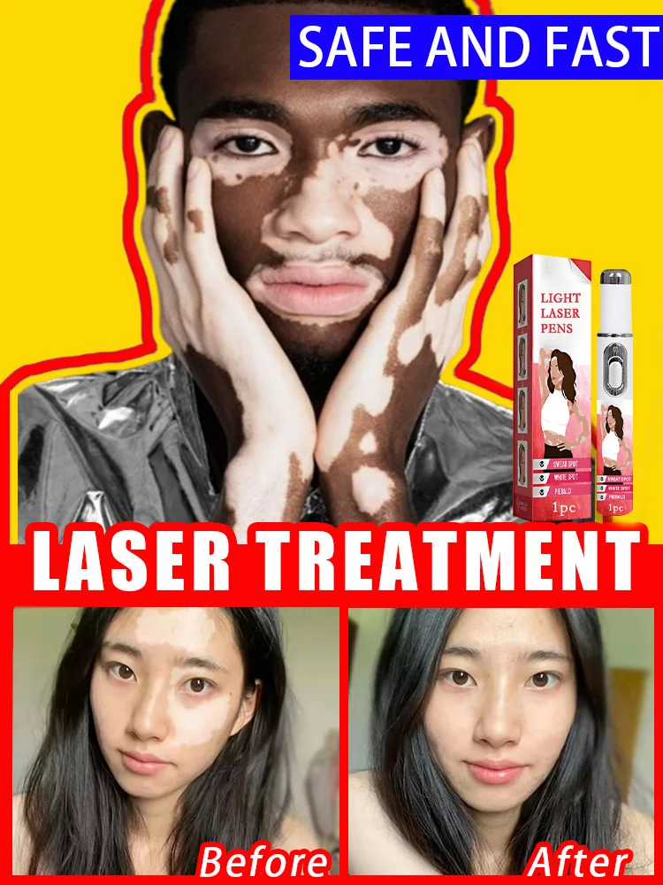 La penna laser migliora il vitiligine