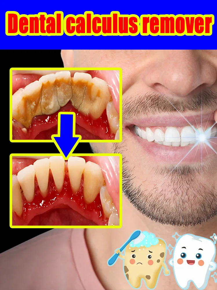 Remover Dental Calculus Whitening Teeth Mouth Odor Removal Bad Breath Preventing Periodontitis