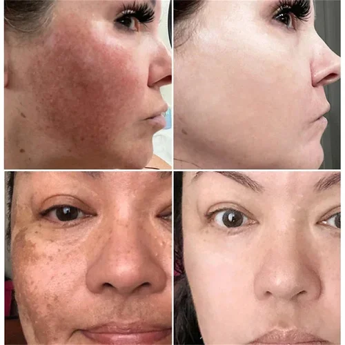 Imagen 2 del producto Potente crema blanqueadora eliminadora de manchas, ilumina la piel, elimina la pigmentación de melanina, Melasma, manchas oscuras, cuidado de la piel facial coreano