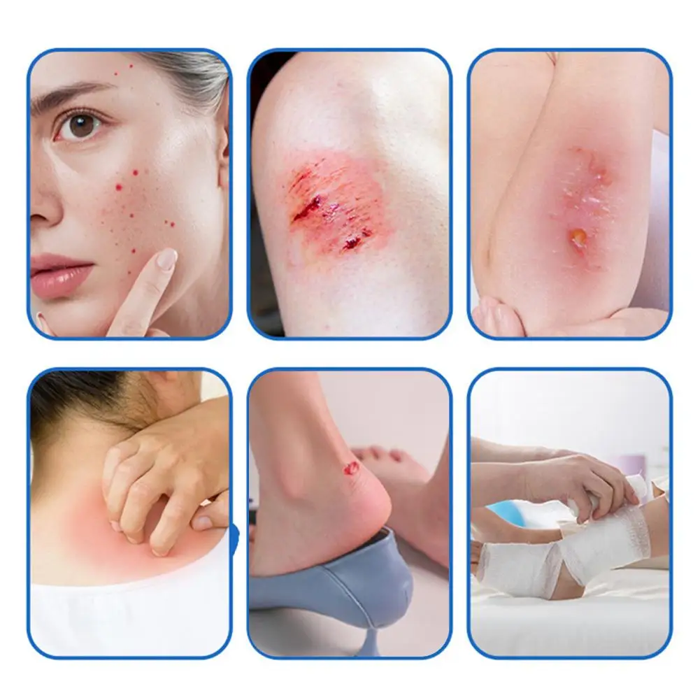 Rouleau de pansement hydrocolloïde auto-adhésif, pansement pour ampoules douloureuses à pression, soin très absorbant, tampon de guérison de la peau