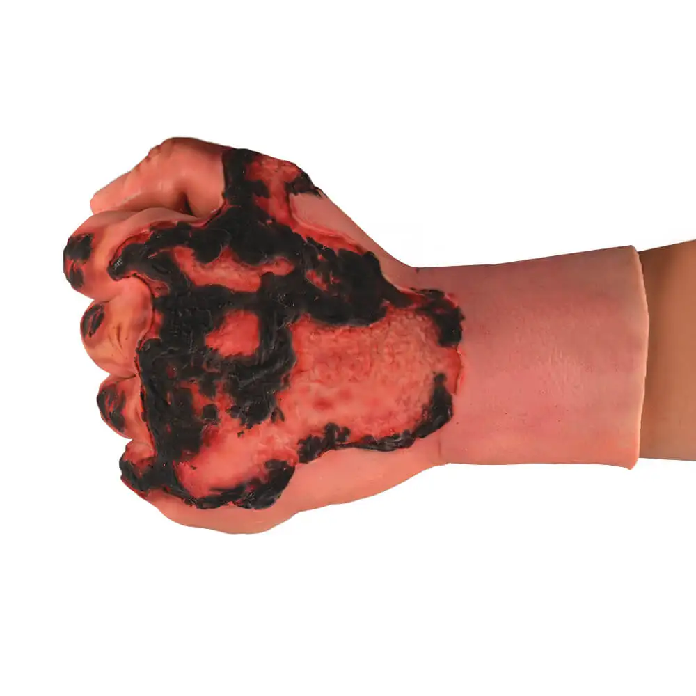 Ultrassist Hand Burn Wound Trainer Wearable Silicone Glove Simulate 3rd Degree Burn Wound for Packing Training Medical Education