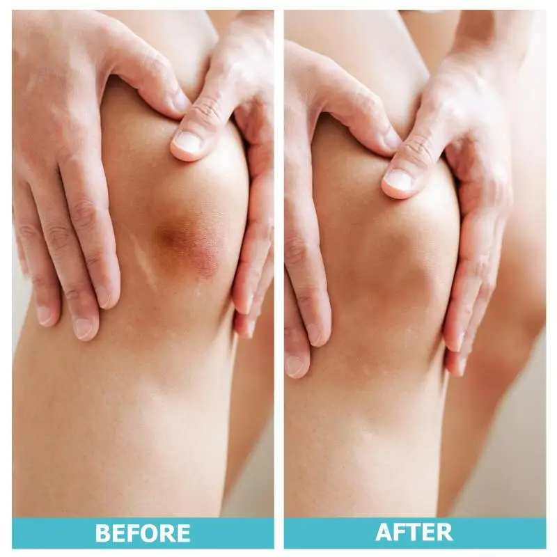 1 rotolo di cerotto idrocolloidale per una cura efficace delle ferite Nastro di copertura cicatrice autoadesivo impermeabile morbido extra sottile