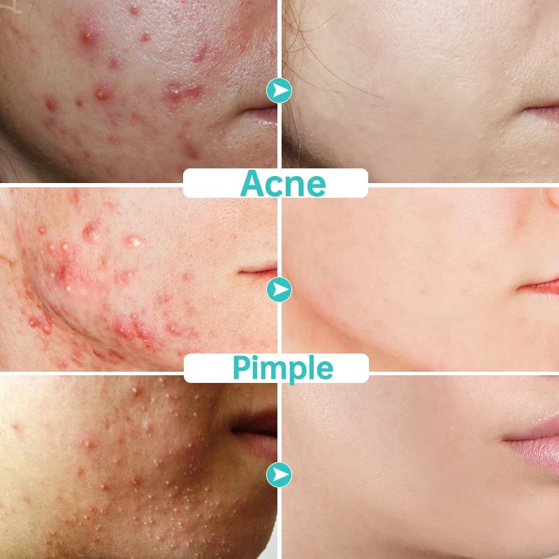 Salicylic Acid Acne Treatment Cream Repair Pimple Spots Deep Cleaning Pore Shrinking Anti-acne Oil Control Moisturizer Skin Care