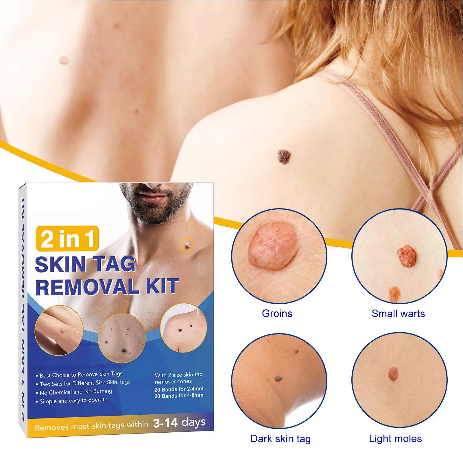 Verbesserte Haut Tag Entferner Stift Haut Tags & Maulwürfe Entfernung Kit schmerzlos und sicher entfernen kleine bis große Größe 2mm bis 8mm Haut Tag