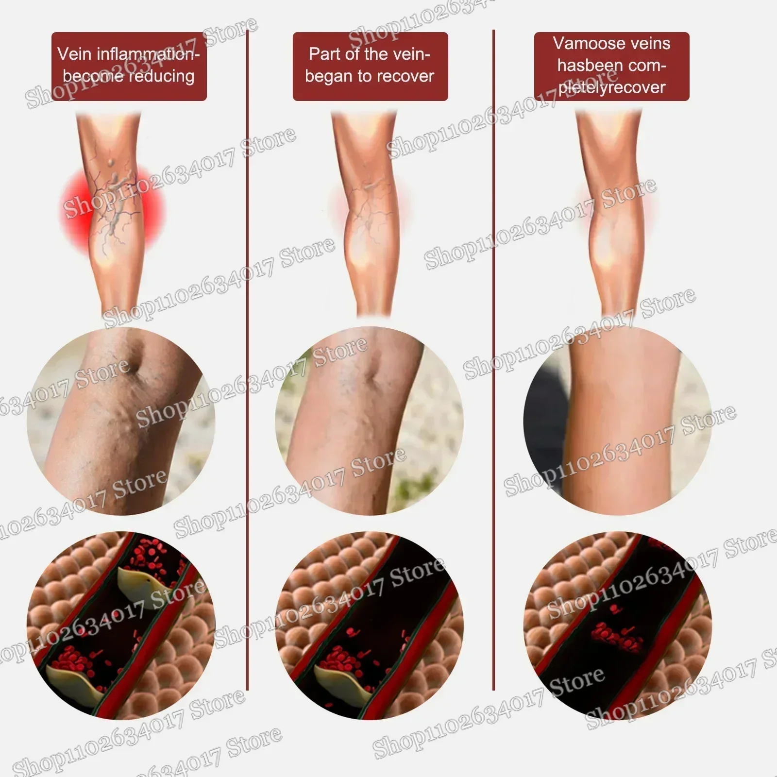 ใหม่ Original Vasculitis การไหลเวียนโลหิตเส้นเลือดขอด Treatment ครีมใหม่ 20g