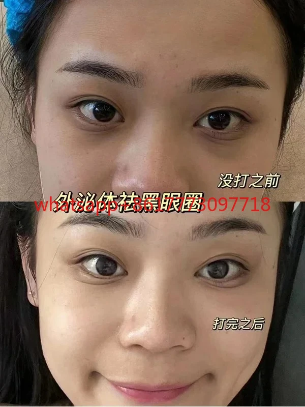 يقدم أداة زرع الخلايا الجسدية exosome توصيل المياه الضحلة والترطيب الخفيف على الوجه