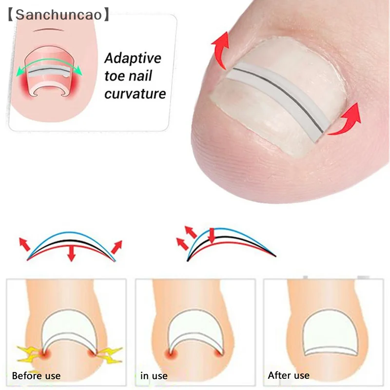 Narzędzie do korekcji wrastających paznokci Klips do prostowania Orteza Wrastający palec u nogi Leczenie paznokci Elastyczna naszywka Narzędzie do pedicure