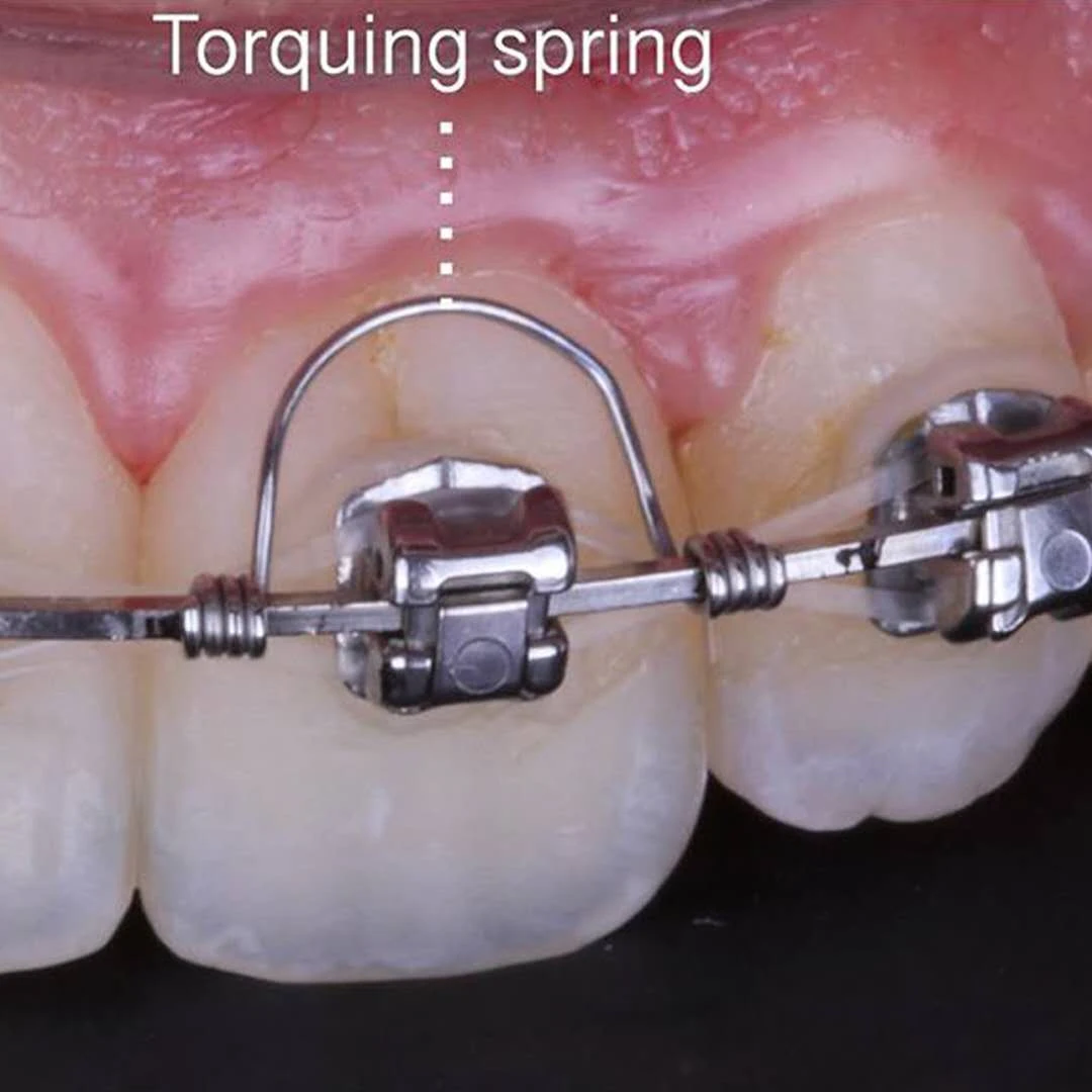 Ressort de couple orthodontique, 10 pièces/sac, ressort de couple antérieur, auxiliaire de couple, Warren, pour orthodontie