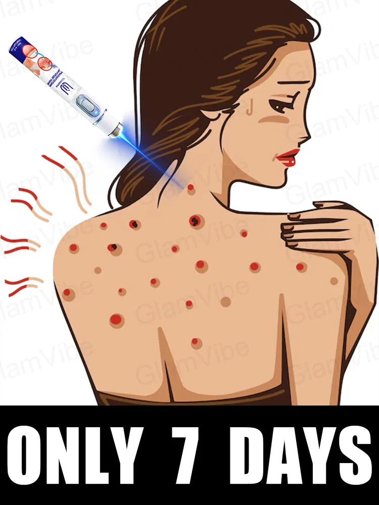 

blue light pen solve warts, hot sale wart care tools